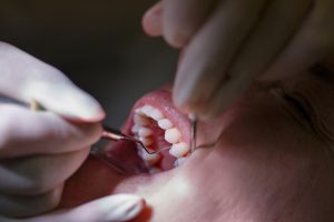 Importance of Treating Periodontal Disease
