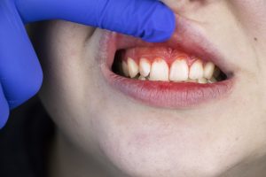 Symptoms of Periodontal Gum Disease