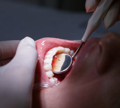 Everything You Need to Know About Periodontal Disease