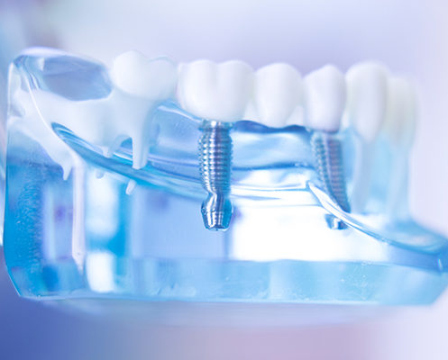 dental implants
