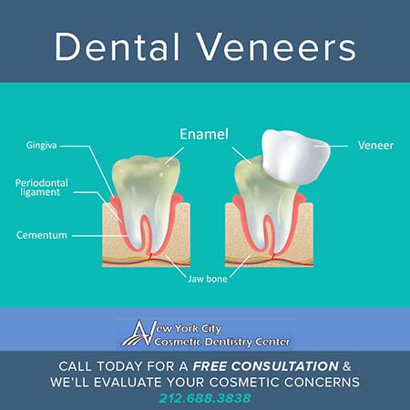 Veneers in NYC Illustrations