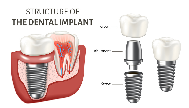 Structure of Dental Implants Graphic