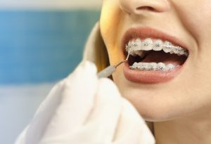 Braces for Adults NYC 