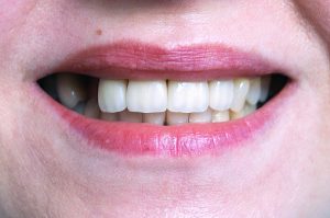 Missing Teeth Cosmetic Dentist
