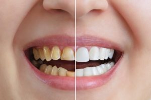 Yellow Teeth - Cosmetic Dentistry NYC
