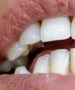 Stains on teeth