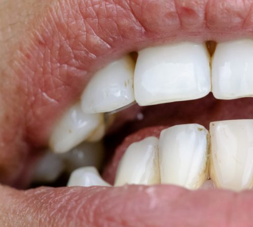 Stains on teeth