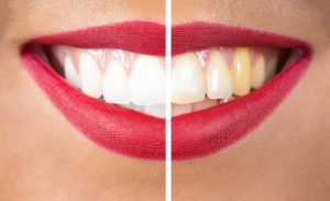 Teeth stain - half white smile, half yellow smile