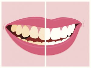 Render of a smile with half white half yellow teeth due to tooth erosion 