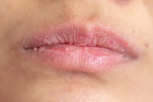 Bad Breath and Dry Mouth