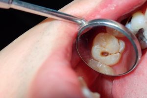 what does a tooth cavity look like