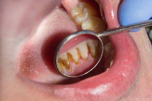 how to prevent a tooth cavity