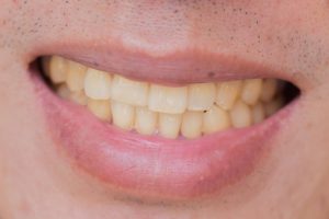 how to prevent teeth stains