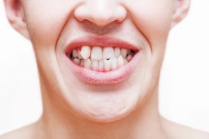 Can Invisalign aligners fix crooked teeth?